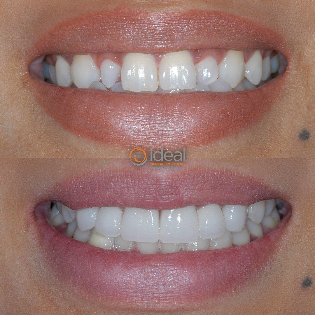 Before and after smile, case 16