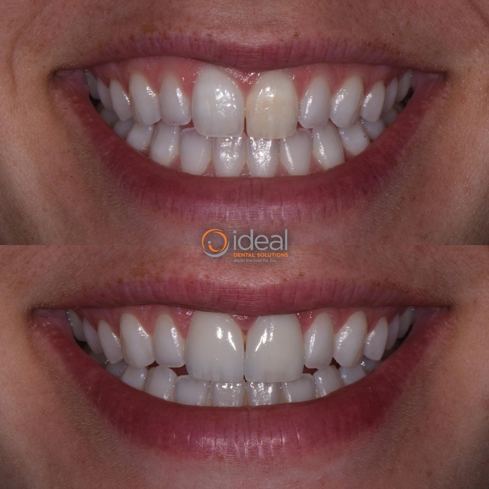 Before and after smile, case 1