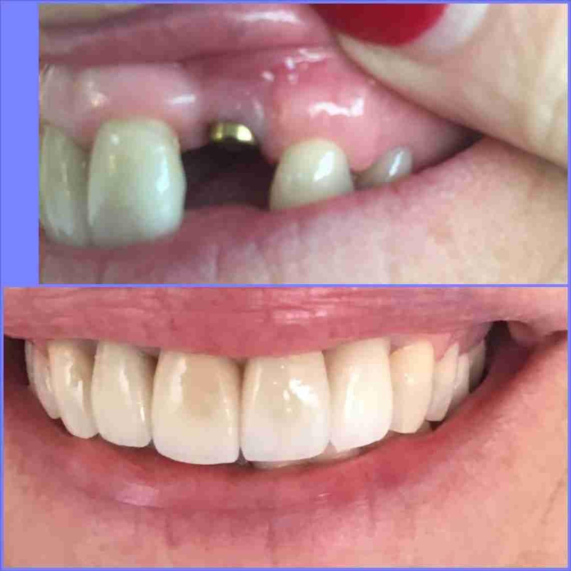 Before and after smile result with a replaced front tooth