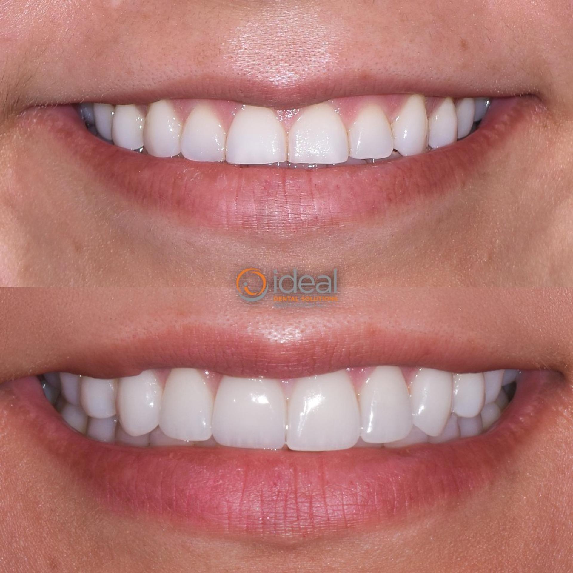 Before and after smile, case 7