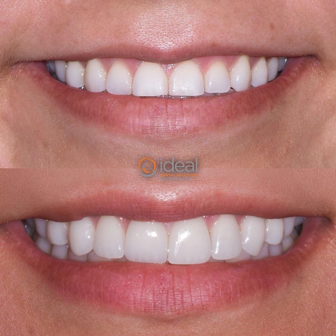 Before and after smile, case 7