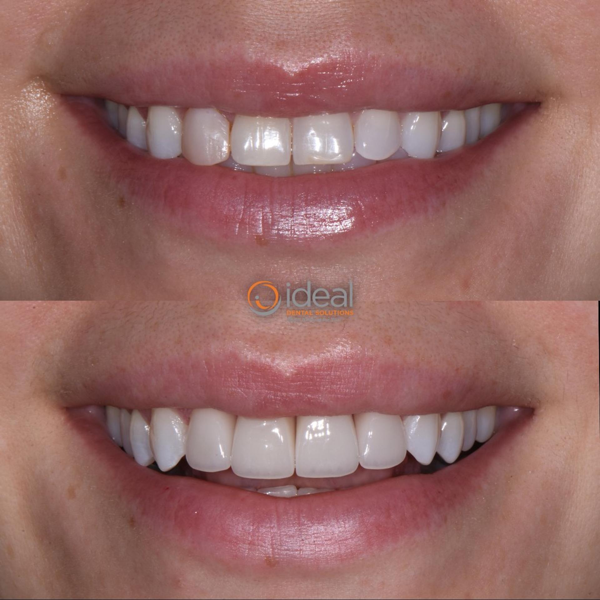 Before and after smile, case 18