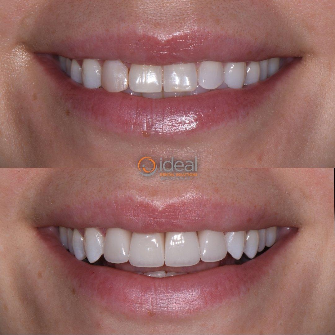 Before and after smile, case 18