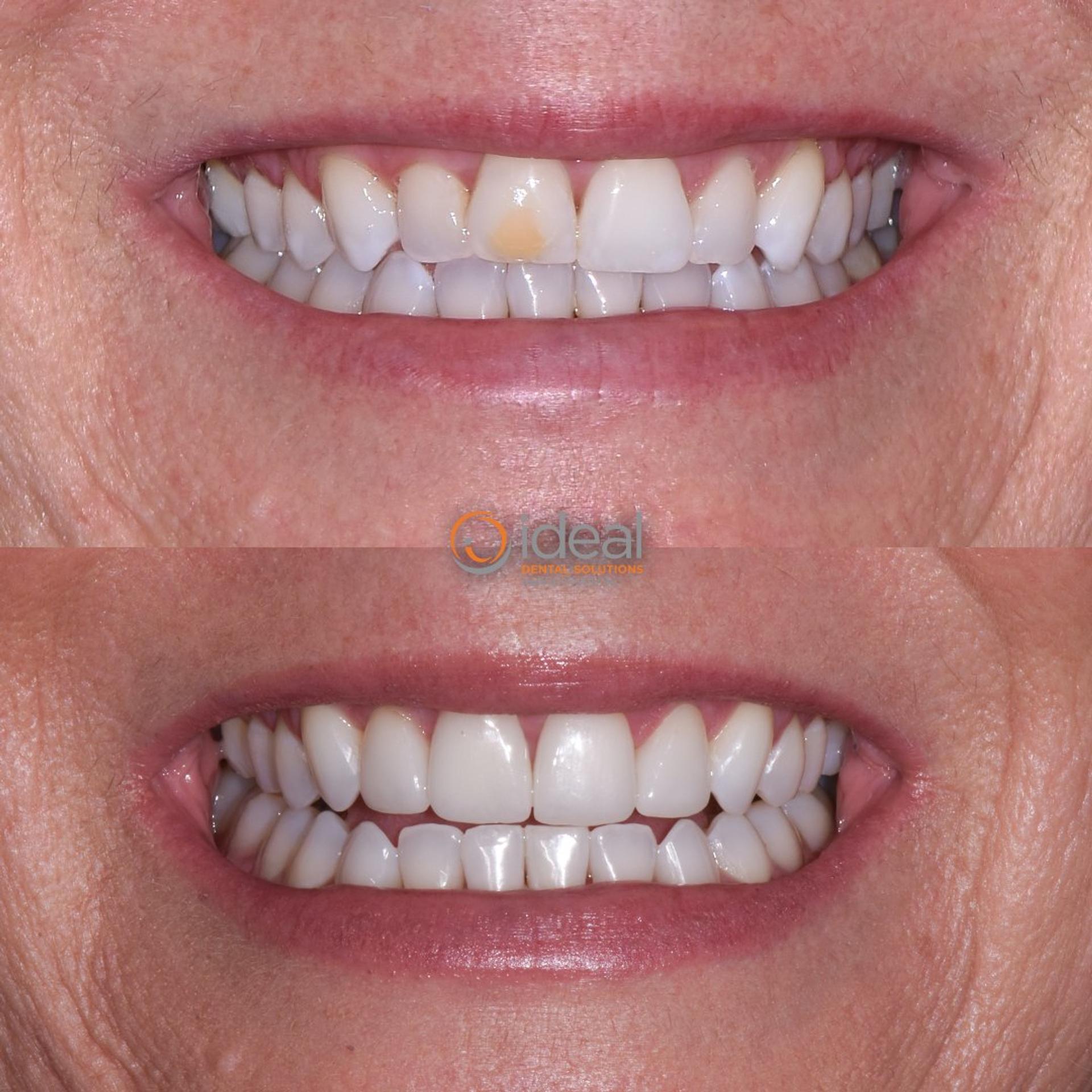 Before and after smile, case 21