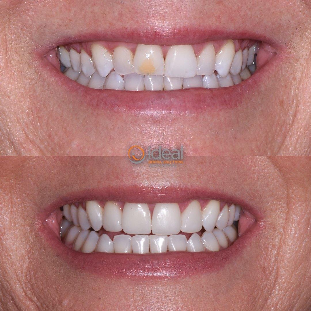 Before and after smile, case 21