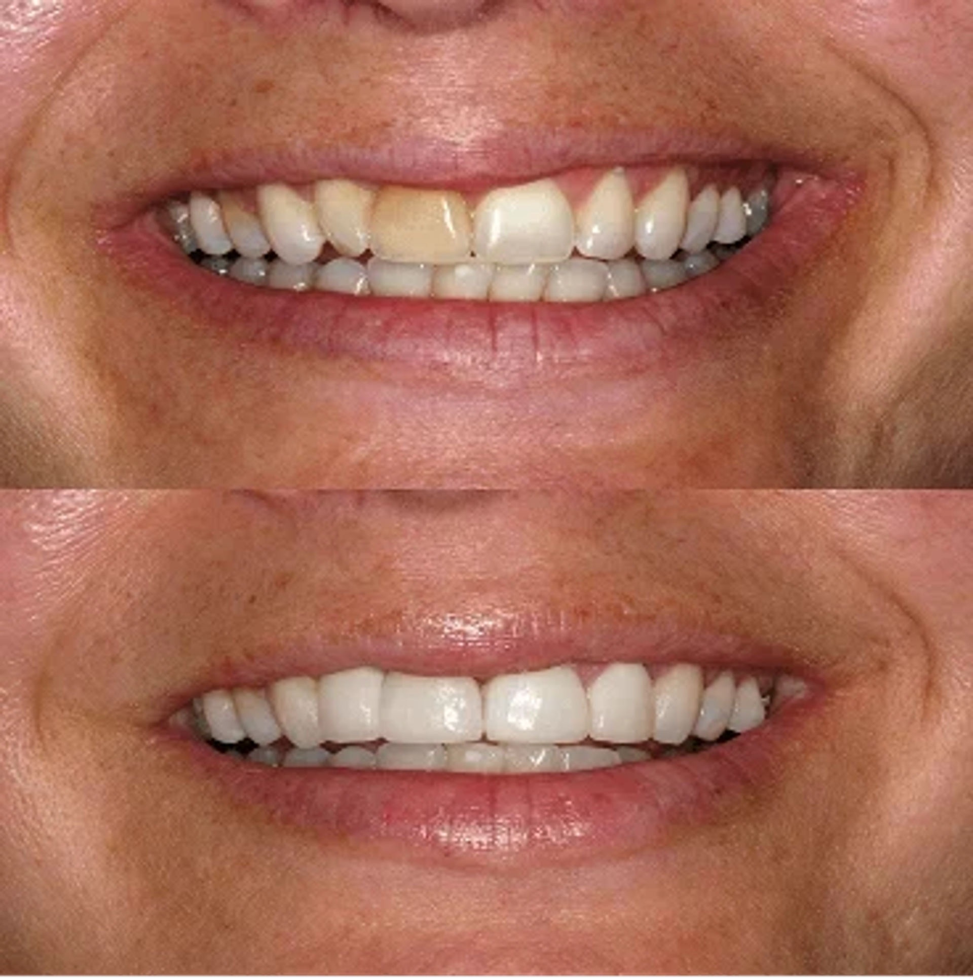 Before and after smile, case 4