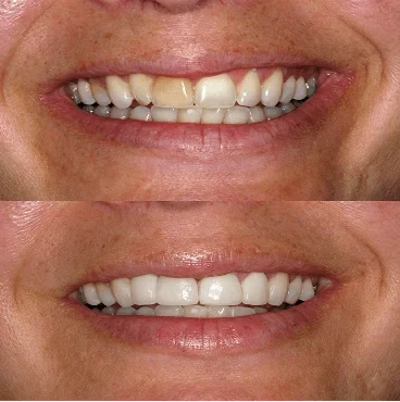 Before and after smile, case 4