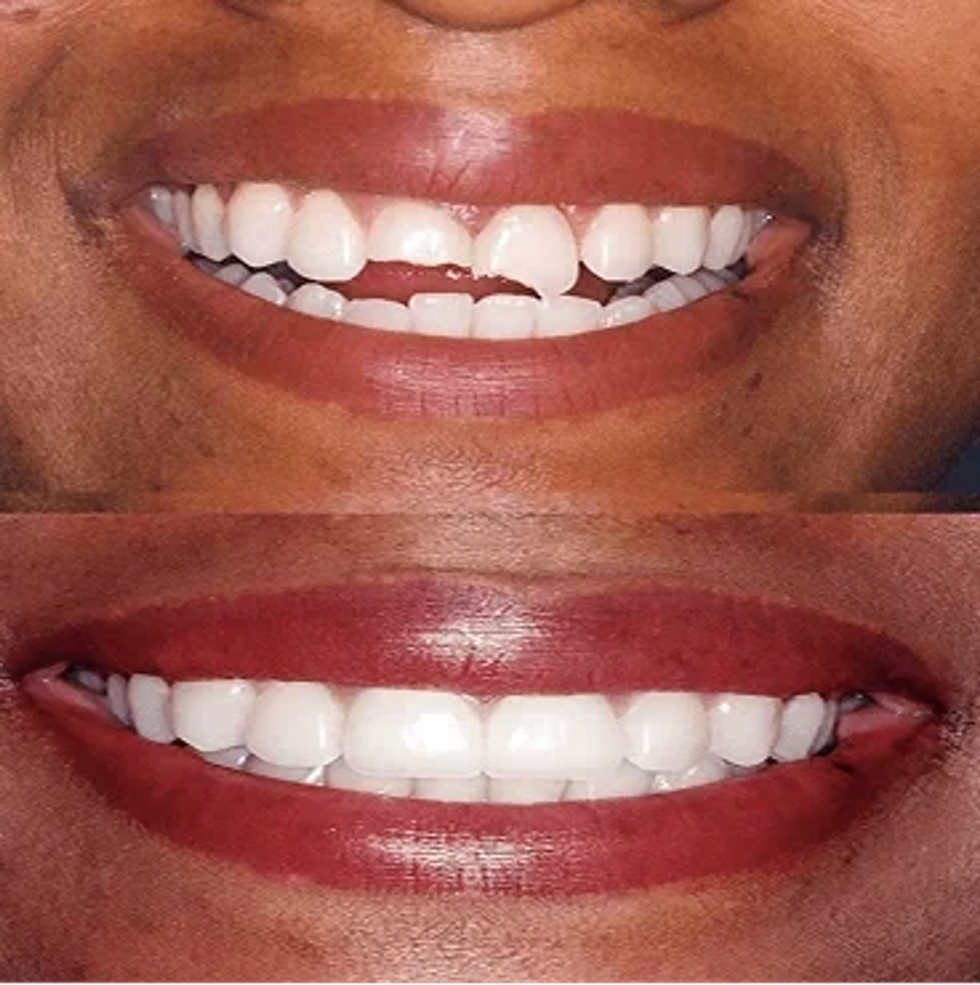 Before and after smile, case 5
