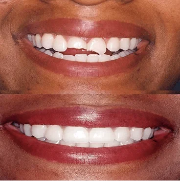 Before and after smile, case 5