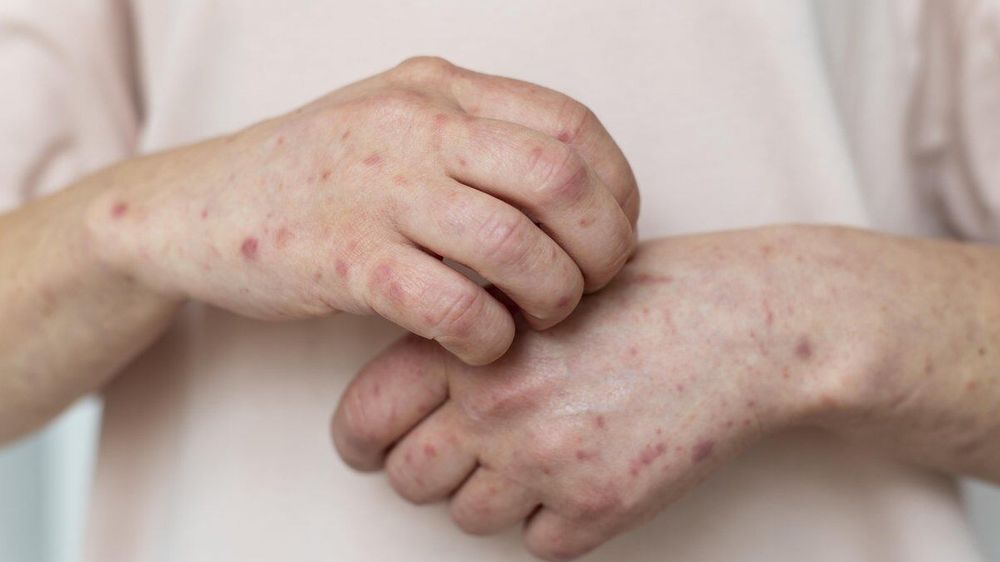Autoridades Sanitarias Confirman Primer Caso de Sarampión del Año en el País