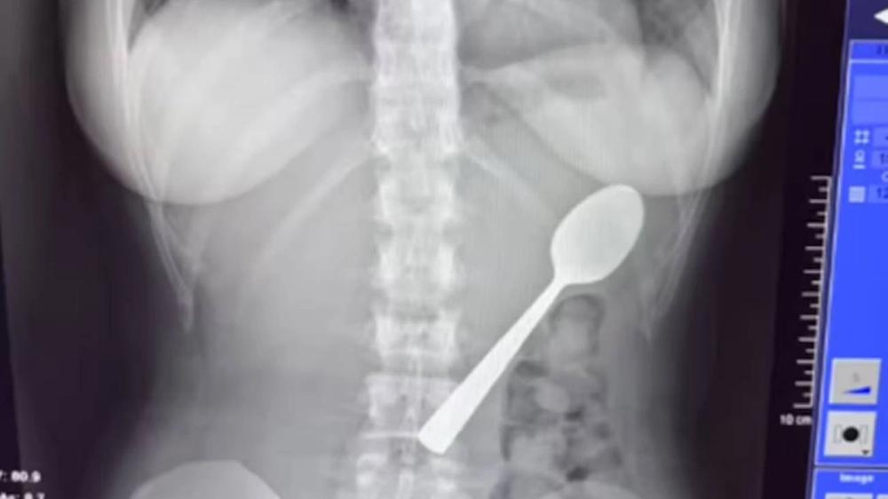 Inusual incidente: Extraen utensilio de cocina del estómago de una mujer tras un sobresalto