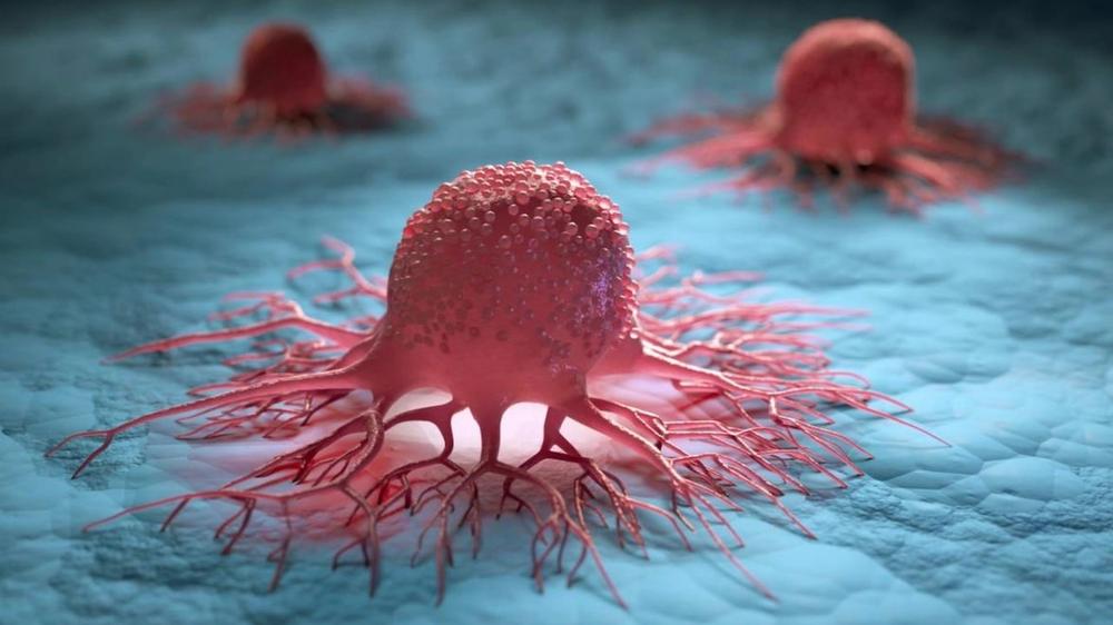 Preocupante incidencia de cáncer de vías biliares en el norte argentino: estudio revela alta tasa de mortalidad