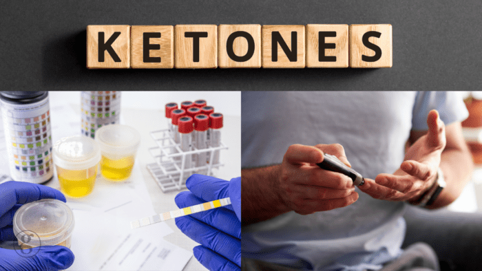 A composite image highlighting the concept of ketones. The top section displays wooden letter tiles spelling "KETONES." The bottom left shows a close-up of gloved hands holding a urine test strip with sample containers and blood test vials in the background. The bottom right features a person pricking their finger with a glucose monitor, indicating ketone or blood sugar testing.