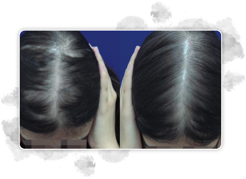 Treatments using a combination of latanoprost and minoxidil “were shown effective in controlling hair loss and increasing the total number of hair strands”.[[#reference_10,10]]