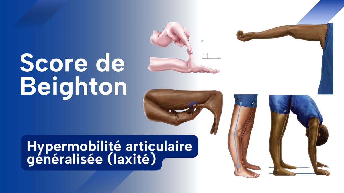 Score de Beighton pour l’hypermobilité articulaire généralisée (laxité)