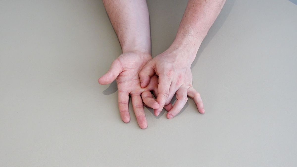 Passive Metacarpophalangeal Flexion Mobilization