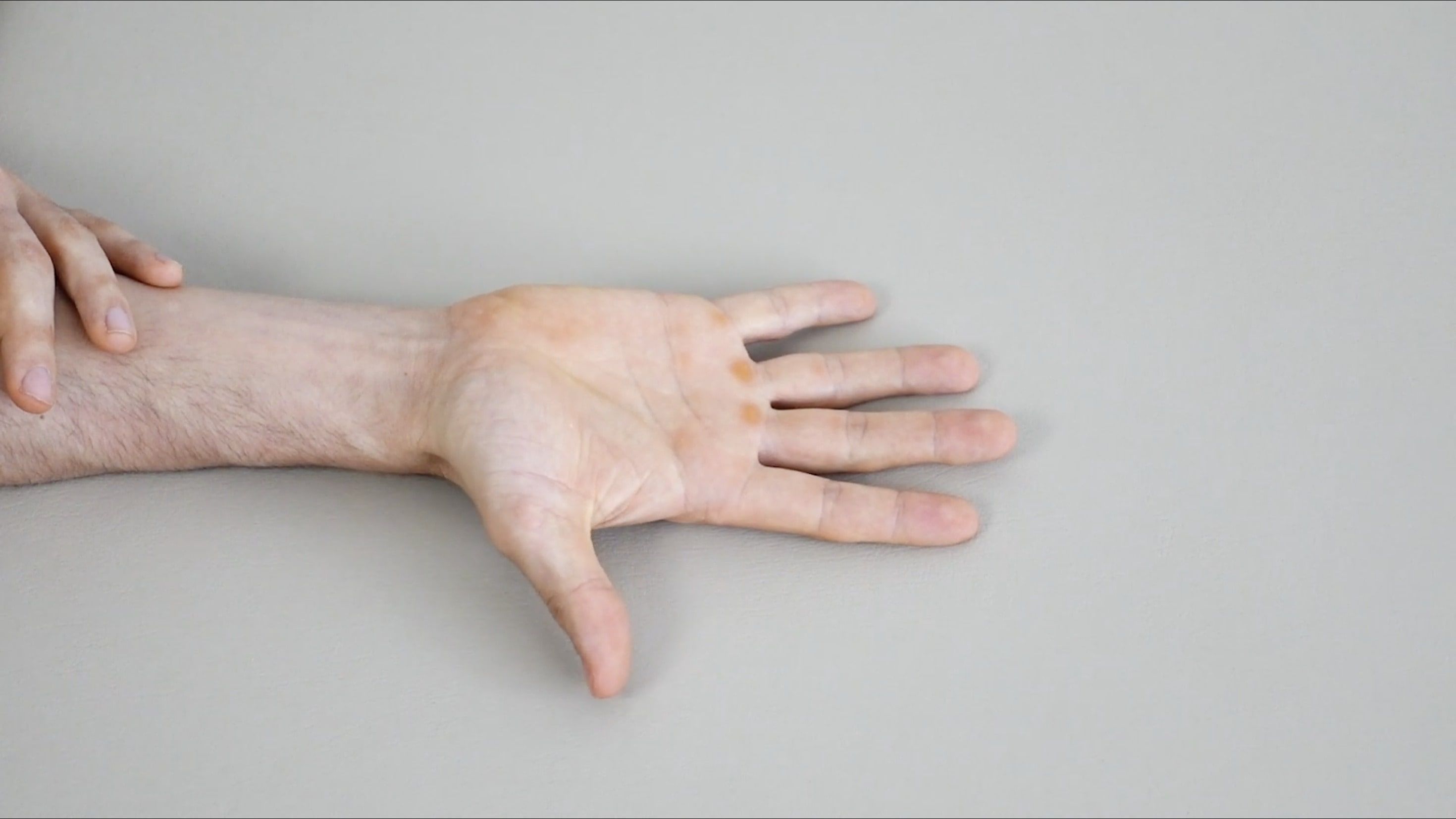 Thumb Flexion Mobilization, view 1