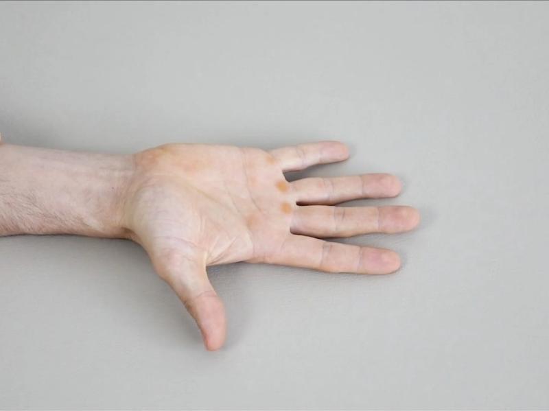 Thumb Flexion Mobilization, view 1