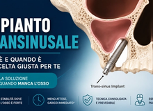 Impianto transinusale: cos'è e quando è la scelta giusta per te?
