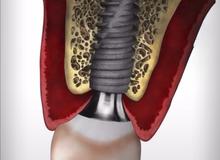 Impianto dentale: quando si può mettere il dente subito e quando invece bisogna aspettare