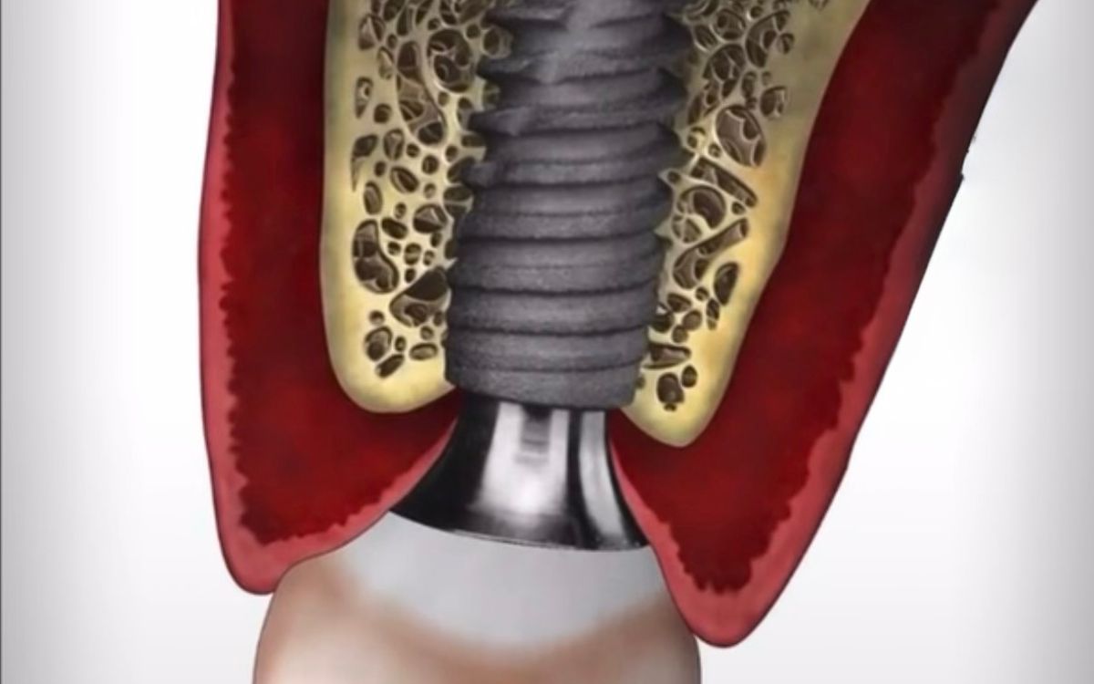 Impianto dentale: quando si può mettere il dente subito e quando invece bisogna aspettare
