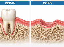 Preservazione di cresta: perché è fondamentale dopo l’estrazione di un dente?