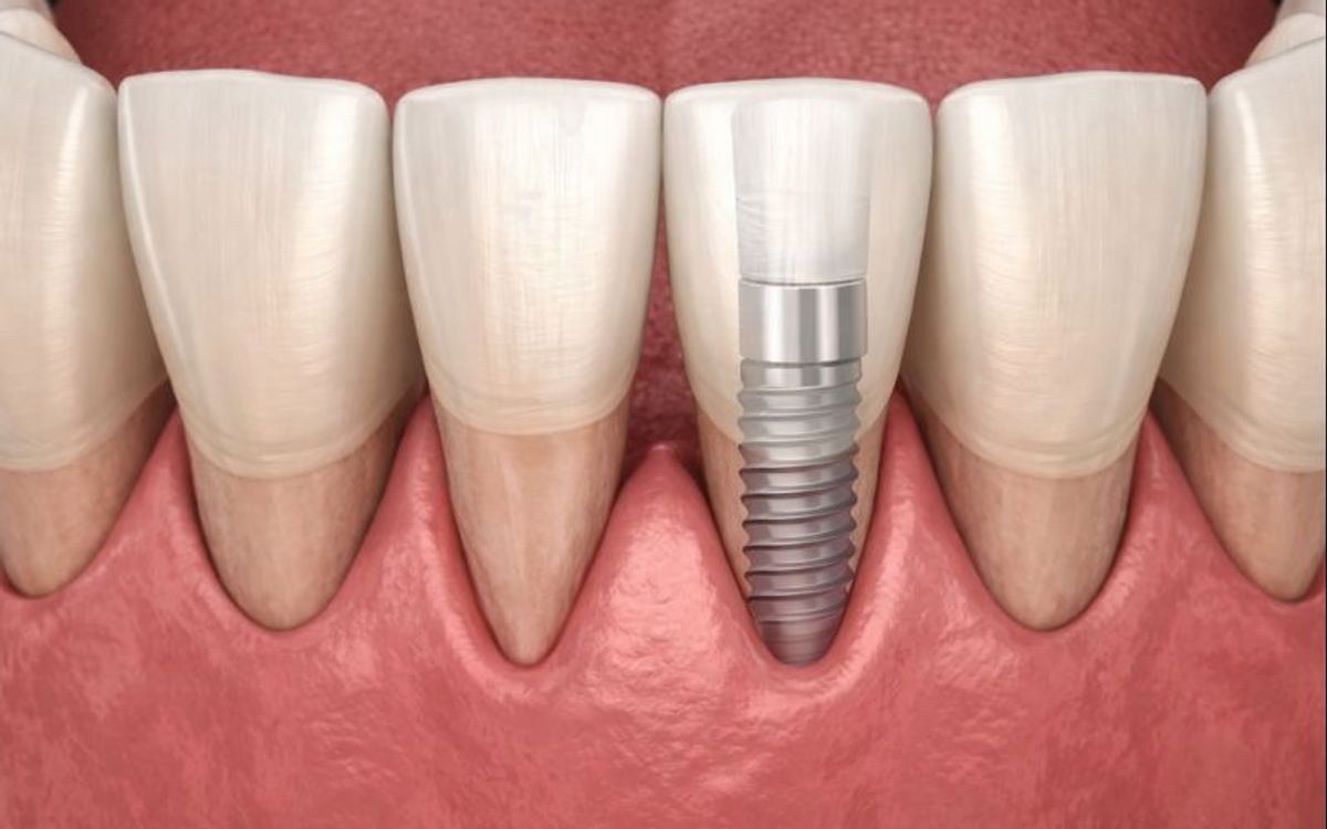 Spazi tra dente e gengiva dopo gli impianti: perché succede e cosa significa