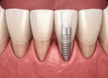 Spazi tra dente e gengiva dopo gli impianti: perché succede e cosa significa