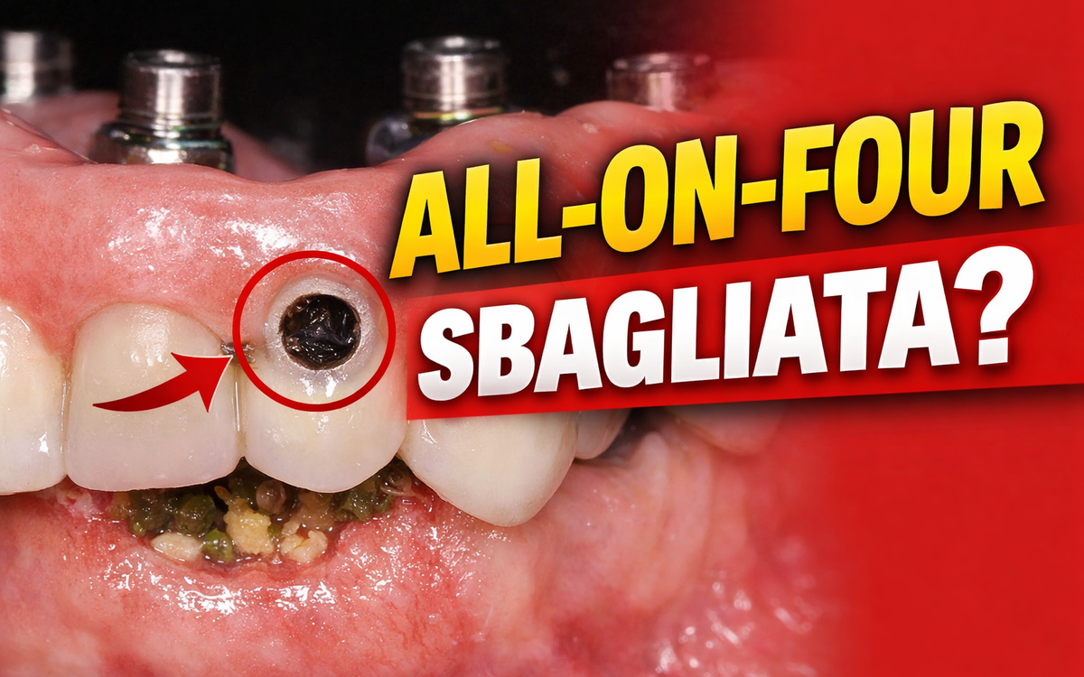 Protesi All-on-Four: come capire se è fatta bene o se presenta errori