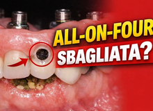 Protesi All-on-Four: come capire se è fatta bene o se presenta errori