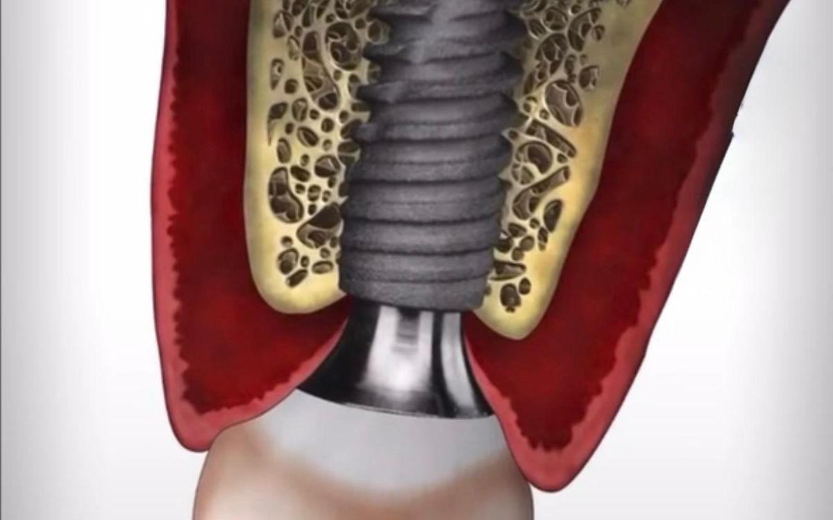 Perché un impianto dentale può fallire? La verità sul “rigetto”