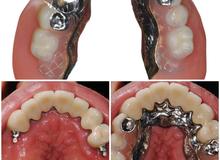 Perché gli scheletrati non vanno più bene o si fanno sempre meno