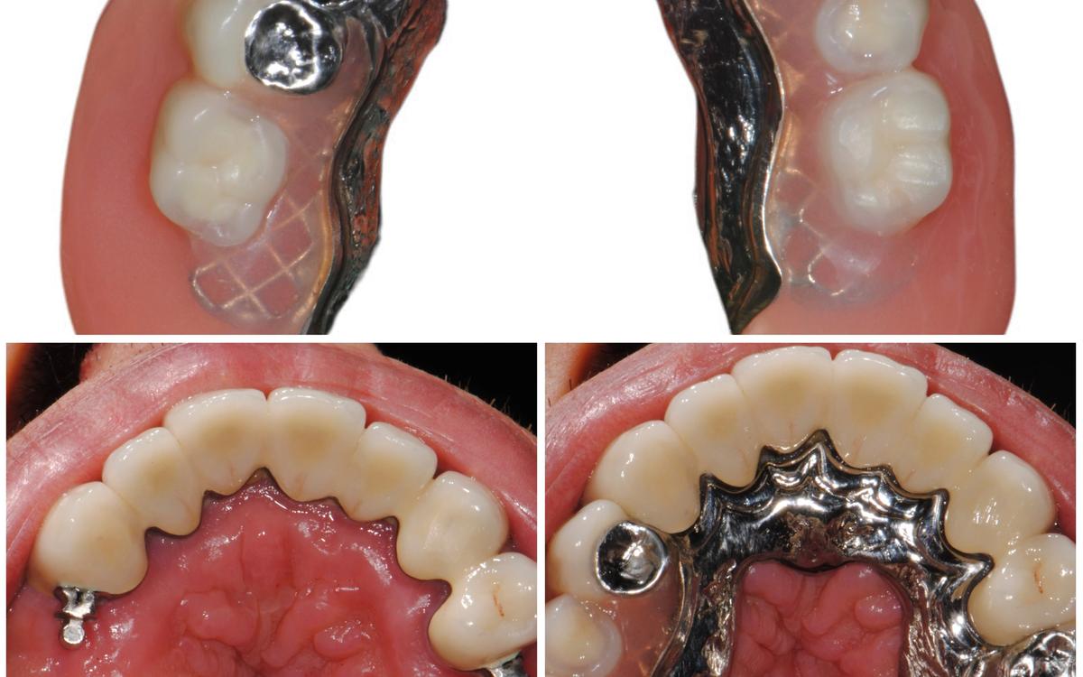 Perché gli scheletrati non vanno più bene o si fanno sempre meno