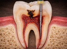 Dente devitalizzato con corona: perché a volte si rompe lo stesso?