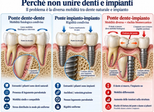 Un impianto attaccato al dente naturale con un ponte? Ti spiego perché dente e impianto lavorano in modo diverso e perché spesso due impianti sono la scelta più sicura.