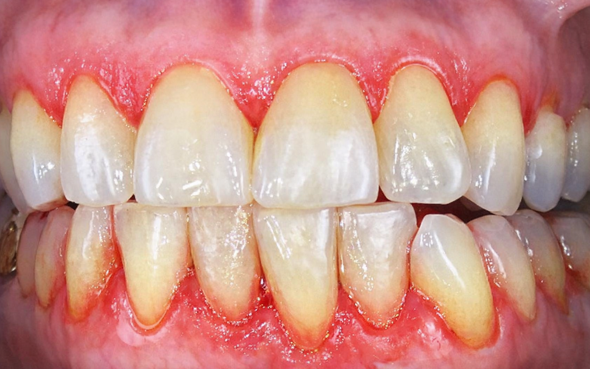 Perché i problemi alle gengive vengono spesso trascurati (e cosa succede se non li curi)