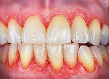 Perché i problemi alle gengive vengono spesso trascurati (e cosa succede se non li curi)