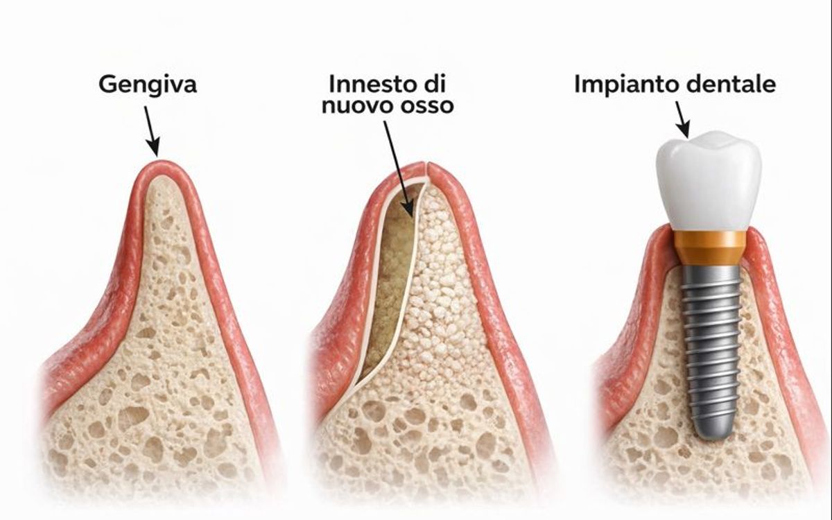 Perché a volte serve rigenerare l’osso e altre volte no?
