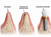 Perché a volte serve rigenerare l’osso e altre volte no?