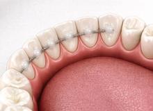 Splintaggio e mascherina di contenzione: perché sono fondamentali dopo l’ortodonzia