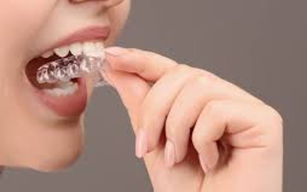 Splintaggio e mascherina di contenzione: perché sono fondamentali dopo l’ortodonzia