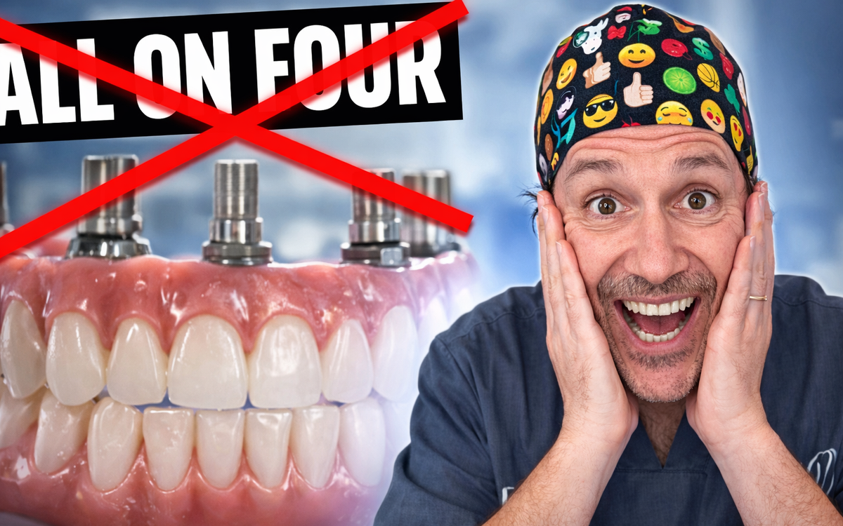 Quando NON fare un All-on-Four: perché togliere tutti i denti può essere un errore