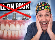 Quando NON fare un All-on-Four: perché togliere tutti i denti può essere un errore