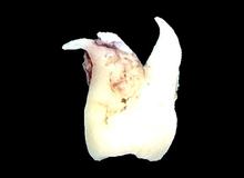 Quando togliere il dente del giudizio? La verità su dolore, nervo e intervento