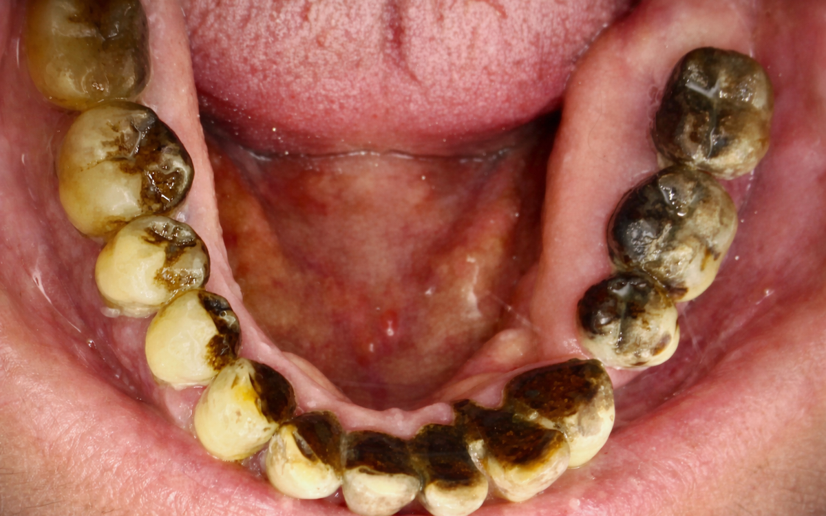 Fumo e denti: i tre “segreti” che in realtà nessuno ti spiega davvero