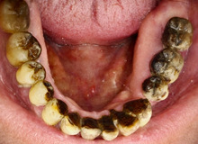 Fumo e denti: i tre “segreti” che in realtà nessuno ti spiega davvero