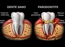 Parodontite: cos’è davvero e perché non puoi permetterti di ignorarla