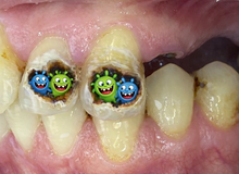 Perché ho ancora carie anche se mi lavo sempre i denti?