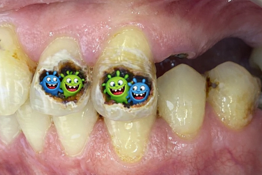 Perché ho ancora carie anche se mi lavo sempre i denti?