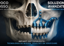 Impianti sottoperiostei (o juxtaperiostei): funzionano davvero quando c'è poco osso?
